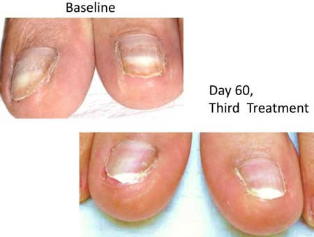 Laser Treatment Fungal toenails