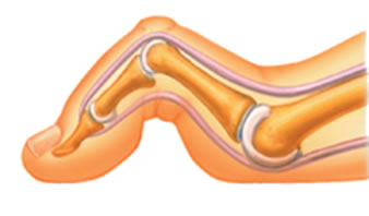 Hammertoe
